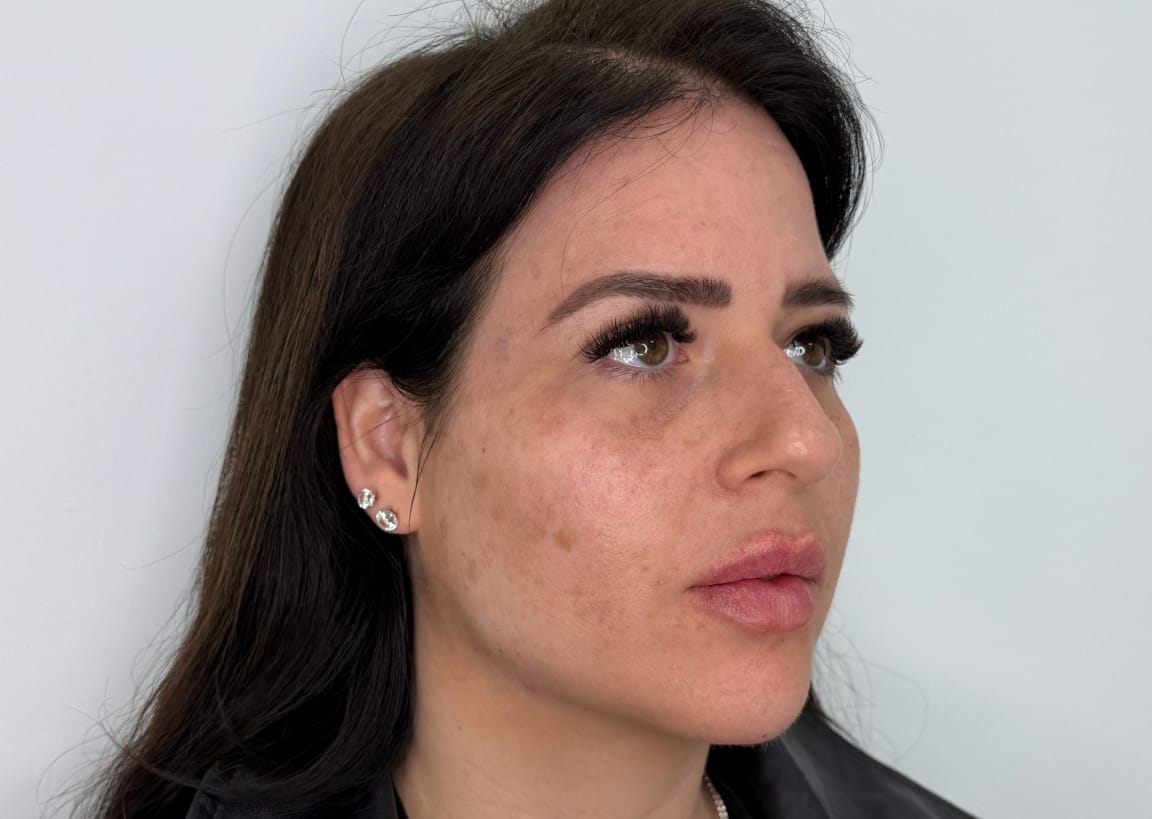 אחרי טיפול פיסול פנים באריאל מדיקל