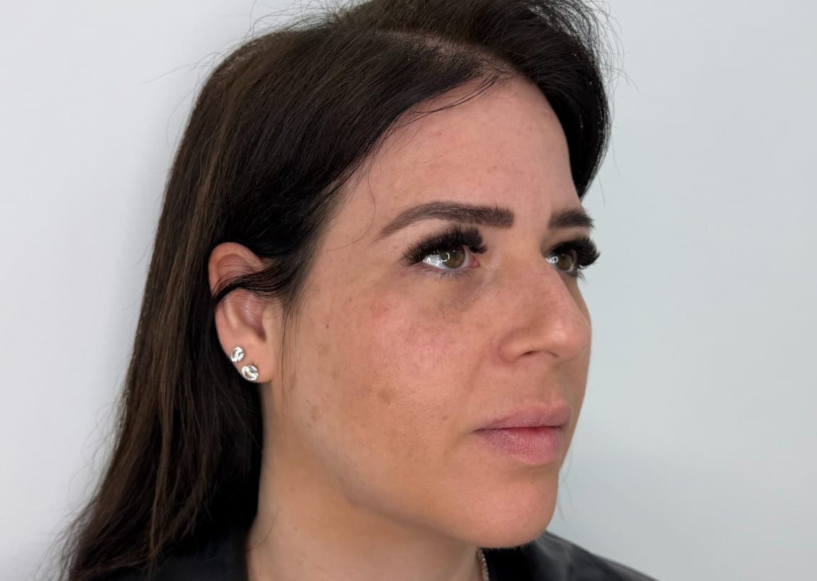 לפני טיפול פיסול פנים באריאל מדיקל