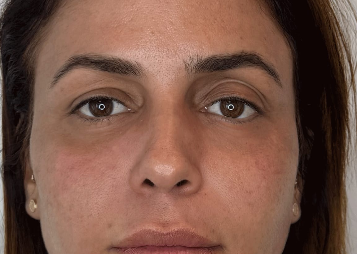 אחרי טיפול מילוי שקעי עיניים באריאל מדיקל